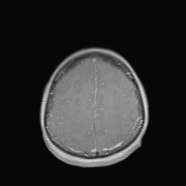 Cerebral abscess (Radiopaedia 24212-24478 Axial T1 C+ 47).jpg