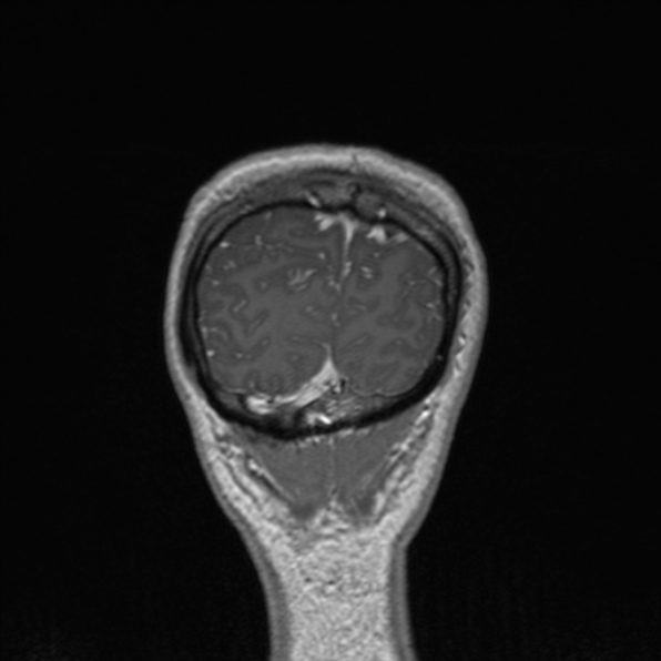 Cerebral abscess (Radiopaedia 24212-24478 Coronal T1 C+ 181).jpg