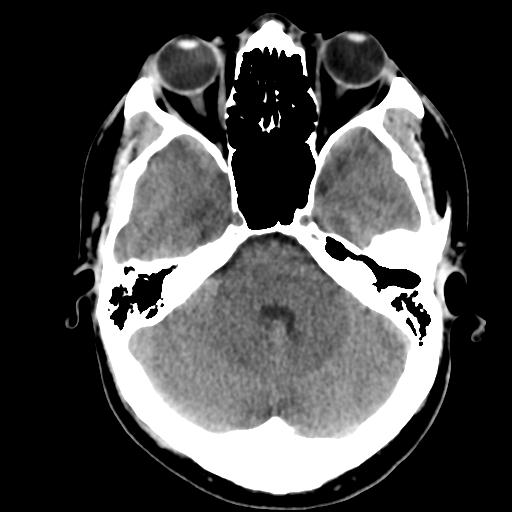 Cerebral abscess (Radiopaedia 29451-29919 Axial non-contrast 14).jpg