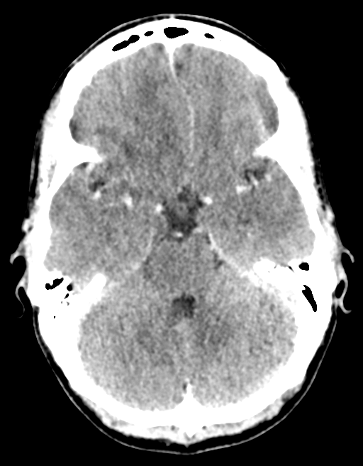 Cerebral abscess (Radiopaedia 60342-68008 Axial C+ delayed 17).png