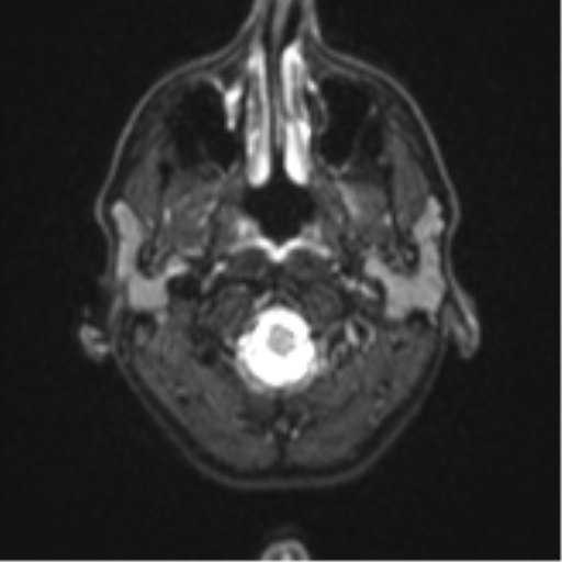 File:Cerebral abscess (Radiopaedia 60342-68009 Axial DWI 1).png