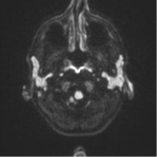 File:Cerebral abscess (Radiopaedia 60342-68009 Axial DWI 37).png