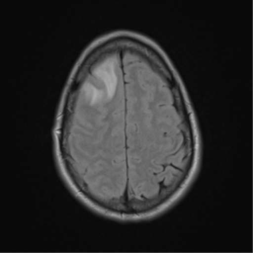File:Cerebral abscess (Radiopaedia 60342-68009 Axial FLAIR 24).png