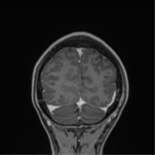 Cerebral abscess (Radiopaedia 60342-68009 H 4).png