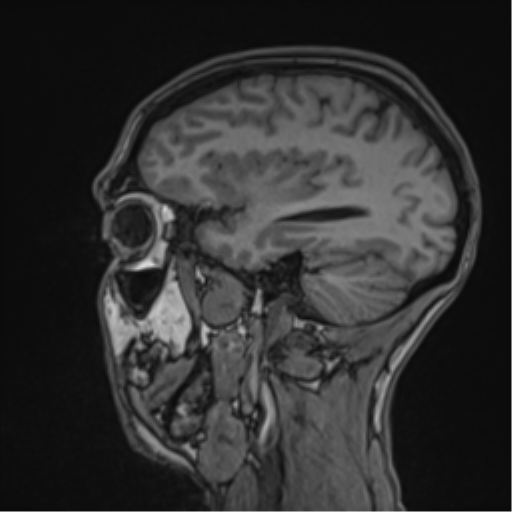 Cerebral abscess (Radiopaedia 60342-68009 Sagittal T1 18).png