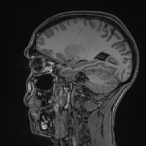 Cerebral abscess (Radiopaedia 60342-68009 Sagittal T1 21).png