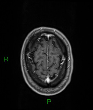 Cerebral abscess and subdural empyema (Radiopaedia 84436-99779 Axial T1 C+ 15).jpg
