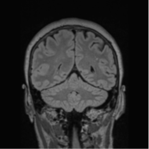 Cerebral abscess from pulmonary arteriovenous malformation (Radiopaedia 86275-102291 Coronal FLAIR 31).png