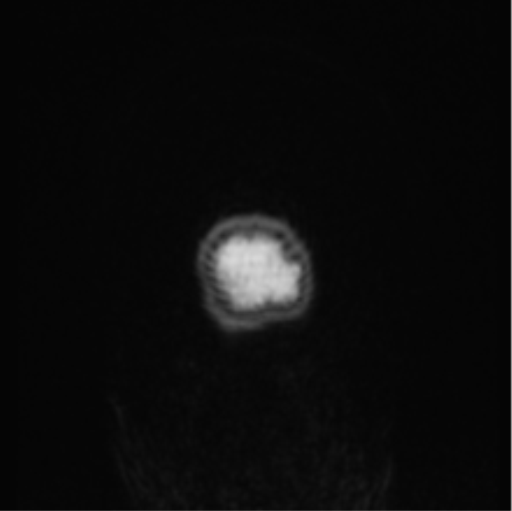 Cerebral abscess from pulmonary arteriovenous malformation (Radiopaedia 86275-102291 Coronal T1 1).png