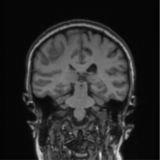 File:Cerebral abscess from pulmonary arteriovenous malformation (Radiopaedia 86275-102291 Coronal T1 39).png