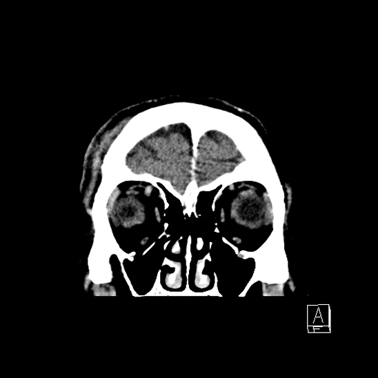 File:Cerebral abscess with ventriculitis (Radiopaedia 78965-91877 B 8).jpg