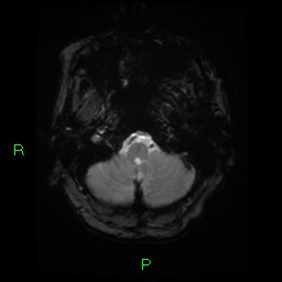 File:Cerebral amyloid angiopathy-associated lobar intracerebral hemorrhage (Radiopaedia 58376-65512 Axial Gradient Echo 23).jpg