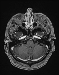 Cerebral amyloid angiopathy-related inflammation (Radiopaedia 58270-65377 Axial T1 C+ fat sat 24).jpg