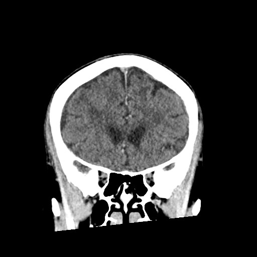 Cerebral amyloid angiopathy-related inflammation (Radiopaedia 74836-85848 Coronal non-contrast 24).jpg