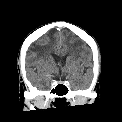 File:Cerebral amyloid angiopathy-related inflammation (Radiopaedia 74836-85848 Coronal non-contrast 32).jpg