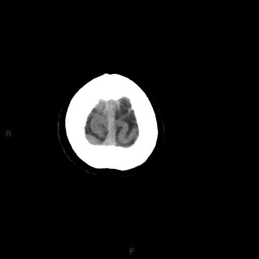 Cerebral amyloid angiopathy (Radiopaedia 77506-89665 Axial non-contrast 106).jpg