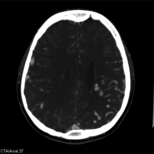Cerebral arteriovenous malformation (Radiopaedia 28518-28759 B 37).jpg