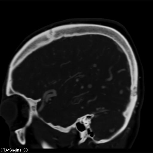 Cerebral arteriovenous malformation (Radiopaedia 28518-28759 D 55).jpg