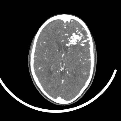 Cerebral arteriovenous malformation (Radiopaedia 29531-30031 E 22).jpg