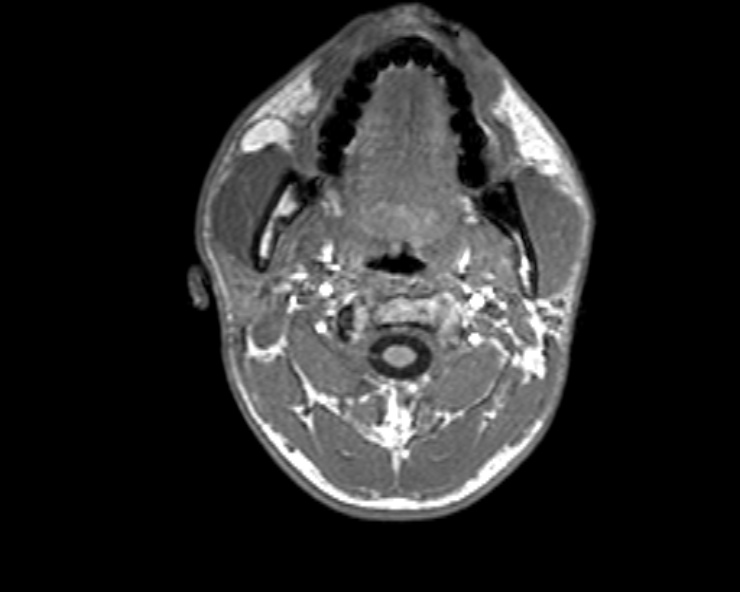 Cerebral arteriovenous malformation (Radiopaedia 30198-30813 Axial T1 57).jpg