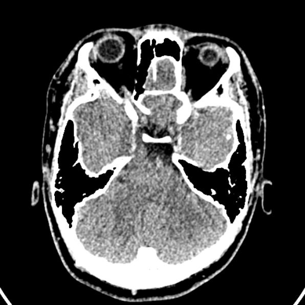 Cerebral arteriovenous malformation (Radiopaedia 37182-39012 Axial non-contrast 13).jpg
