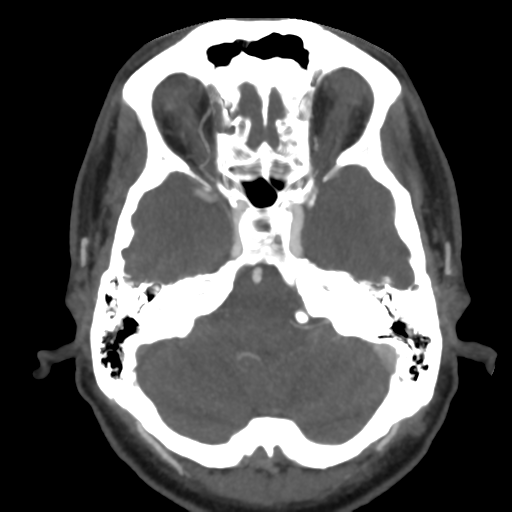 Cerebral arteriovenous malformation (Radiopaedia 39259-41505 AX CEREBRAL CTA 14).png