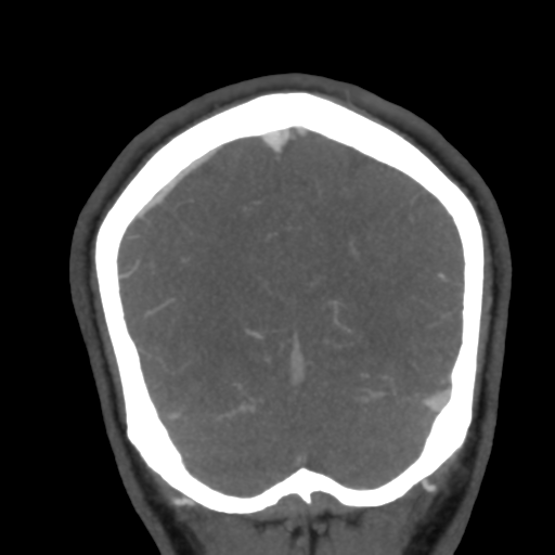 Cerebral arteriovenous malformation (Radiopaedia 39259-41505 E 56).png
