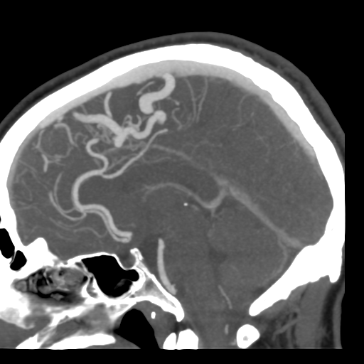 Cerebral arteriovenous malformation (Radiopaedia 39259-41505 Sagittal 31).png