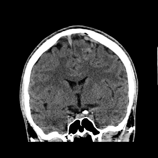 Cerebral arteriovenous malformation (Radiopaedia 61964-70028 Coronal non-contrast 27).jpg