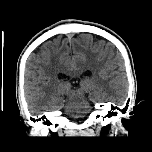 Cerebral arteriovenous malformation (Radiopaedia 61964-70028 Coronal non-contrast 36).jpg