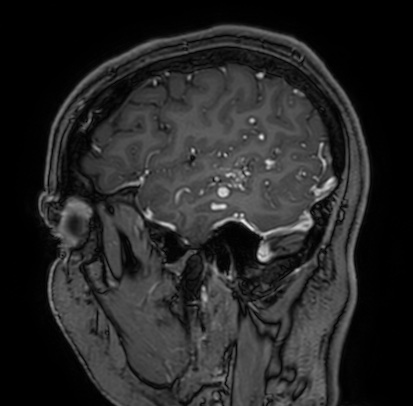 Cerebral arteriovenous malformation (Radiopaedia 74411-85654 Sagittal T1 C+ 19).jpg