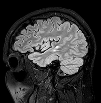 Cerebral arteriovenous malformation (Radiopaedia 74411-85746 Sagittal FLAIR 23).jpg