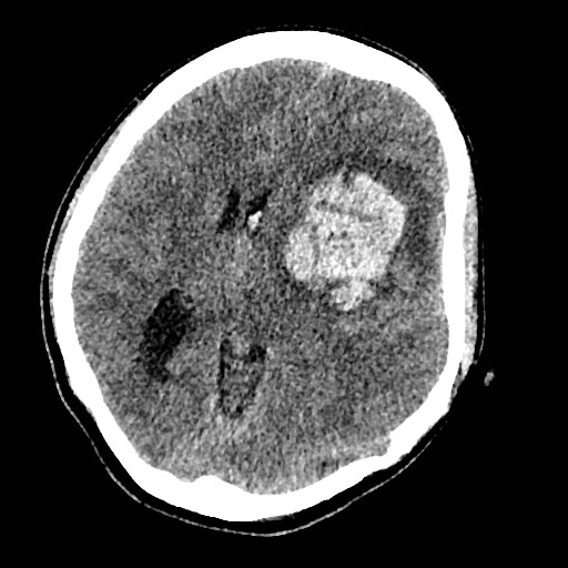 Cerebral arteriovenous malformation (Radiopaedia 79677-92887 Axial non-contrast 20).jpg