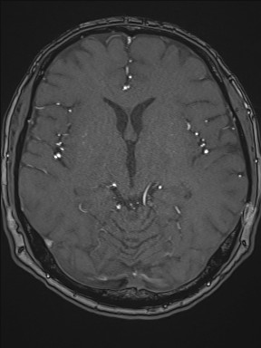 Cerebral arteriovenous malformation (Radiopaedia 84015-99245 Axial TOF 121).jpg