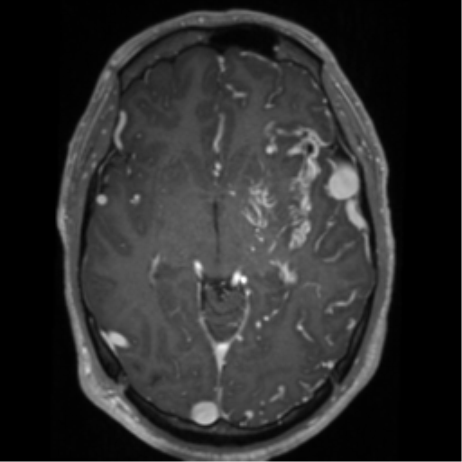 Cerebral arteriovenous malformation - huge (Radiopaedia 35734-37272 Axial T1 C+ 31).png