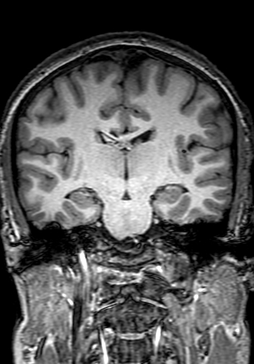 File:Cerebral arteriovenous malformation at posterior body of corpus callosum (Radiopaedia 74111-84925 Coronal T1 177).jpg