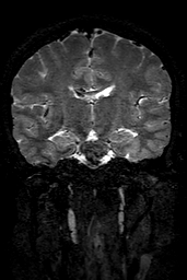 Cerebral arteriovenous malformation at posterior body of corpus callosum (Radiopaedia 74111-84925 Coronal T2 90).jpg
