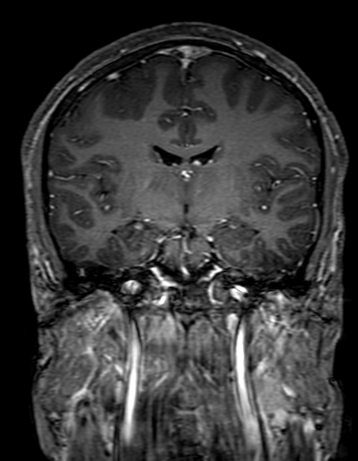 Cerebral arteriovenous malformation at posterior body of corpus callosum (Radiopaedia 74111-84925 K 181).jpg