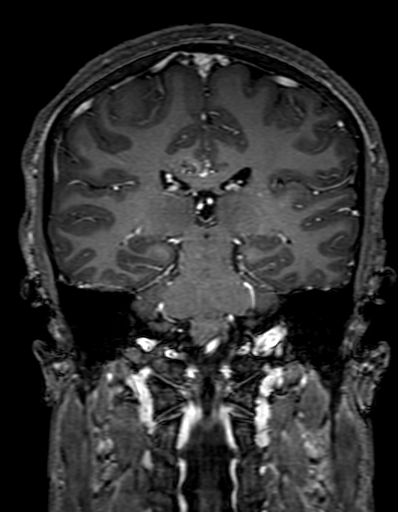 Cerebral arteriovenous malformation at posterior body of corpus callosum (Radiopaedia 74111-84925 K 219).jpg