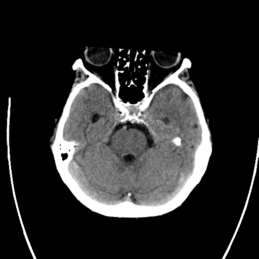 File:Cerebral arteriovenous malformation with lobar hemorrhage (Radiopaedia 44725-48512 Axial non-contrast 14).png