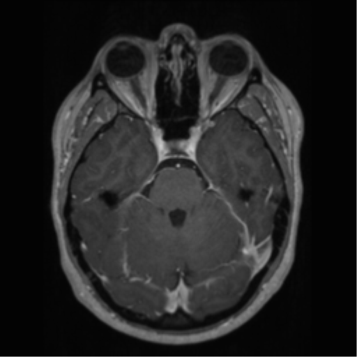 File:Cerebral cavernoma and development venous anomaly (Radiopaedia 37603-39482 Axial T1 C+ 25).png