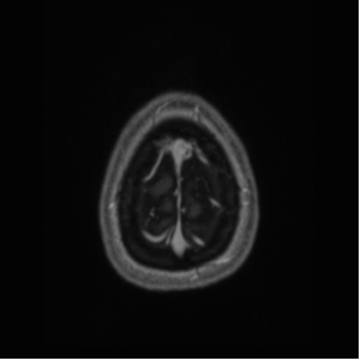 File:Cerebral cavernoma and development venous anomaly (Radiopaedia 37603-39482 Axial T1 C+ 72).png