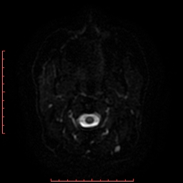 File:Cerebral cavernous malformation (Radiopaedia 26177-26306 Axial DWI 21).jpg