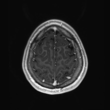 Cerebral cavernous venous malformation (Radiopaedia 70008-80021 Axial T1 C+ 89).jpg