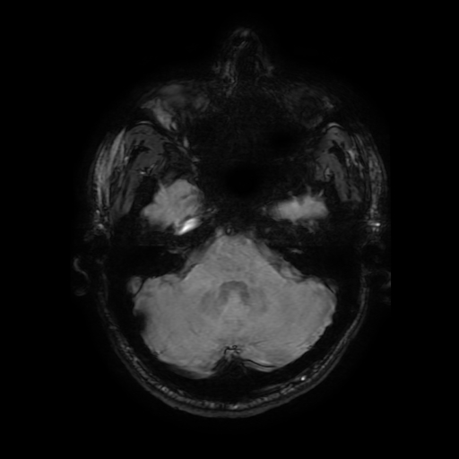 Cerebral cavernous venous malformation (Zabramski type II) (Radiopaedia 85511-101198 Axial SWI 37).jpg
