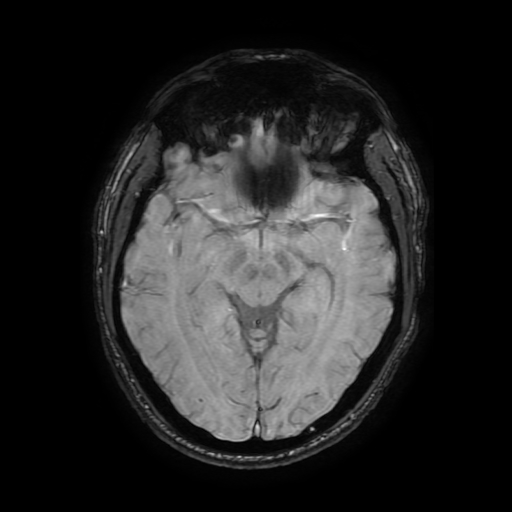 File:Cerebral cavernous venous malformation (Zabramski type II) (Radiopaedia 85511-101198 Axial SWI 58).jpg