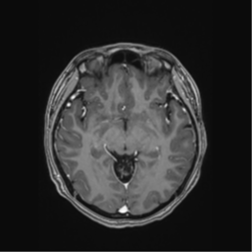 Cerebral cavernous venous malformations (Radiopaedia 48117-52946 Axial T1 C+ 25).png