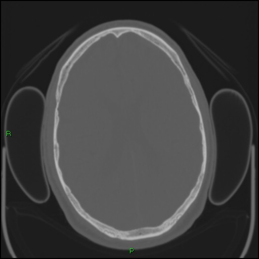 Cerebral contusions (Radiopaedia 33868-35039 Axial bone window 130).jpg
