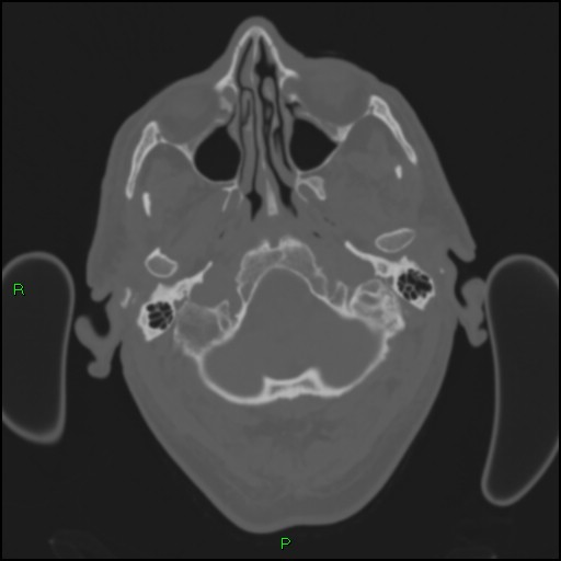 Cerebral contusions (Radiopaedia 33868-35039 Axial bone window 20).jpg
