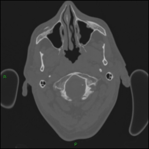 File:Cerebral contusions (Radiopaedia 33868-35039 Axial bone window 8).jpg